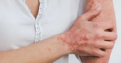 Síntomas de la balanitis.
