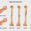 tipos de fracturas